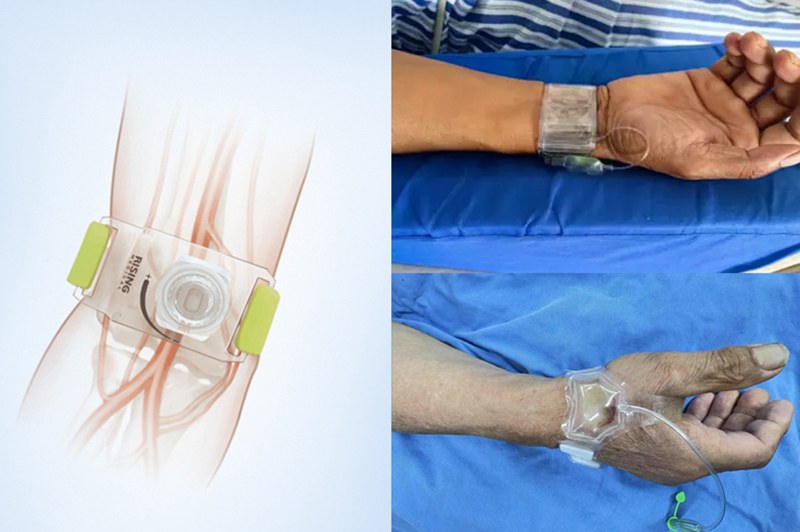Development of radial artery approach: why hemostatic devices are replacing manual compression
