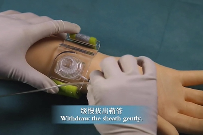 桡动脉止血带进行术后止血并监测桡动脉血流.jpg